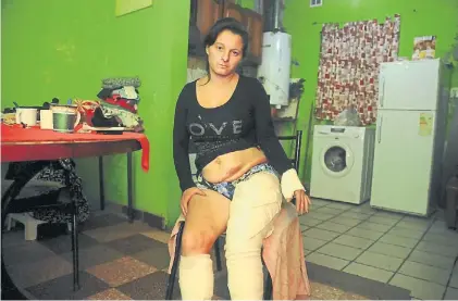  ?? LA CAPITAL ?? Aterrada. “Me quemó las piernas, las manos y un poco la cara”, dijo Yésica Castillo en su casa.