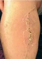  ?? PHOTOS: NICHOLAS BOYACK/FAIRFAX NZ ?? Daniel Kean’s infected leg.