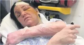  ??  ?? SHOCKING Burns are visible on Theresa’s arms, neck and head as she lies in hospital