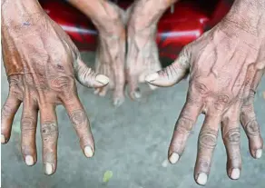  ??  ?? Pulling out more than 80kg of nails from trees have scarred Sarder’s hands and feet.