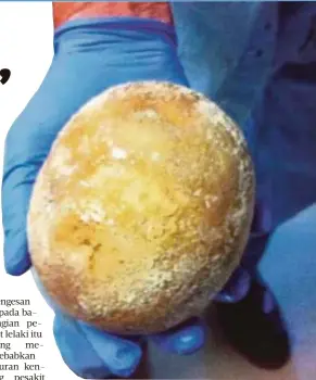  ??  ?? BATU karang hampir sebesar telur burung unta yang dikeluarka­n daripada perut pesakit itu. - Agensi