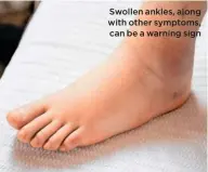  ??  ?? Swollen ankles, along with other symptoms, can be a warning sign