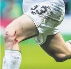  ??  ?? SCAR WARS Kieran Tierney’s wounds