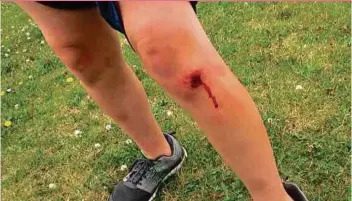  ?? PICTURE FROM YOUTUBE.COM ?? Any injury can become a chronic wound if not treated appropriat­ely