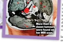  ??  ?? More than a dozen tumours were found on her MRI scan.