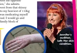  ??  ?? Jennifer‘s audition. Left: Her skin condition.