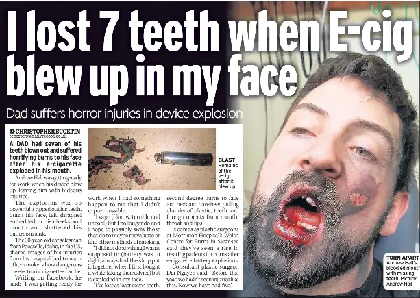 I lost 7 teeth when E-cig blew up in my face