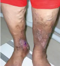  ??  ?? Varicose ulcers developed due to mismanagem­ent of varicose veins