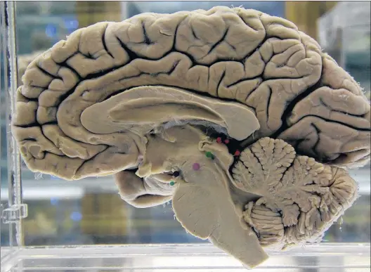  ?? THE ASSOCIATED PRESS ?? A section of a preserved human brain on display at the Museum of Neuroanato­my at the University at Buffalo, in Buffalo, N.Y. A study released Tuesday offers more evidence of a link between traumatic brain injuries and dementia later in life, with...