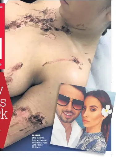  ??  ?? BURNS One victim’s injuries caused by Collins, right with Ferne McCann