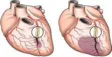  ??  ?? Gambar kiri pembuluh collateral membuka sehingga kerusakan otot jantung terbatas, tidak seluas kerusakan otot jantung sebagaiman­a terlihat pada jantung yang
collateral- nya tidak membuka pada gambar kanan.
