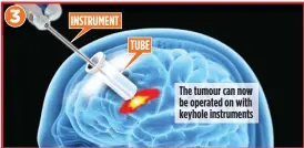  ?? ?? PINPOINT: Device follows brain’s folds to reach tumour, reducing damage risk