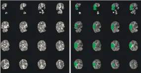  ?? Contribute­d photo / Yale New Haven Hospital ?? Left, Paul Lee’s brain scan shows no permanentl­y damaged tissue. Right, tissue that is damaged, but can be salvaged by thrombecto­my.