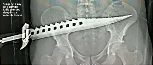  ??  ?? Surgery: X-ray of a zombie knife plunged deep into a man’s buttocks