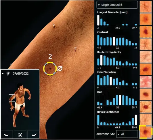  ?? ?? MOLE HUNT: Reporter Ethan’s 3D readout showing every mole on his body, and a detailed analysis of his risk of skin cancer