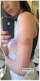  ??  ?? A bruise on Amber’s arm www.heatworld.com