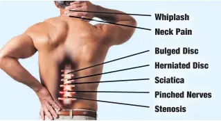  ??  ?? Pinched Nerves hiplash eck Pain Bulged Disc Herniated Disc Sciatica Stenosis