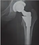  ??  ?? An artificial hip joint.