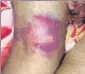  ??  ?? The injury marks on Amit Jindal’s body, allegedly due to police brutality.