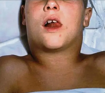  ??  ?? Symptoms of diphtheria include fever, sore throat, headache, breathing difficulty, white/grey patches on the tonsils, swollen glands, tiredness and bull neck.