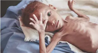  ?? – Associated Press: Hani Mohammed ?? Au Yémen, où des milliers de civils ont trouvé la mort dans les frappes aériennes d’une coalition dirigée par l’Arabie saoudite, le groupe humanitair­e Save the Children calcule que 85 000 enfants de moins de cinq ans pourraient être morts de faim ou de maladie pendant la guerre civile.