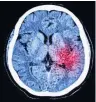  ??  ?? BRAIN SCAN After stroke