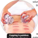  ?? ?? Cupping is painless but causes bruises.