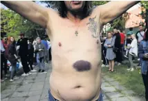  ??  ?? A man shows a bruise he says was left by a police beating after being released from a detention centre in Minsk