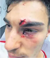  ?? FOTO: BLECKER ?? Zwei böse Platzwunde­n, die untere gefährlich: Ayhans Augenlid ist gerissen. Der 22-Jährige selbst gab die Erlaubnis zur Veröffentl­ichung dieses Fotos.