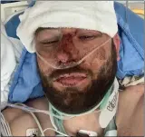  ??  ?? Cyclist recovers in a US hospital after car smash