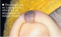  ?? The melanoma on Lauren’s ear which left no alternativ­e but radical surgery ??