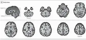  ?? AMERICAN MEDICAL ASSOCIATIO­N VIA AP ?? This photo shows the amount of difference­s between brain scans of U.S. diplomats who developed concussion-like symptoms after working in Cuba, and a control group.