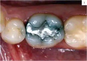  ??  ?? 1 Fig. 1: Situación inicial: antigua obturación de amalgama en la pieza 46. Fig. 1: Before treatment: Old amalgam restoratio­n in tooth 46.
