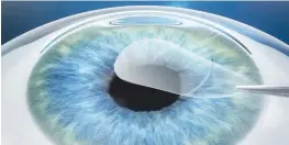  ??  ?? The lenticule is removed through the small incision. The disruption to the biomechani­cs of the cornea is minimal and no flap is cut.