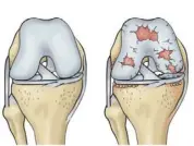  ?? ?? Diagram of a normal knee (left) and an osteoarthr­itic knee.