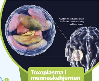  ??  ?? Cyster inne i hjernen kan forårsake betennelse og
død i nervevev.