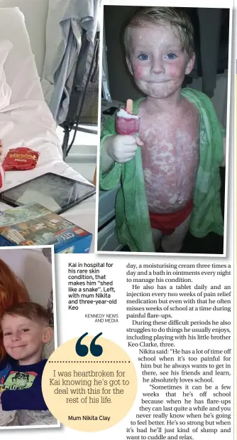  ?? Kennedy news and Media ?? Kai in hospital for his rare skin condition, that makes him “shed like a snake”. Left, with mum Nikita and three-year-old Keo
News