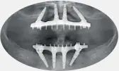  ??  ?? Configurat­ion of dental implants used to support the bridges