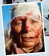  ?? ?? SAVED: Olena Kurylo in Poland now and, inset, bloodied and bandaged early in the war