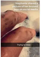  ??  ?? Stephanie shared a picture of her bruised legs on social media