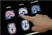  ?? MATT YORK — THE ASSOCIATED PRESS FILE ?? A doctor looks at a PET brain scan at the Banner Alzheimers Institute in Phoenix.