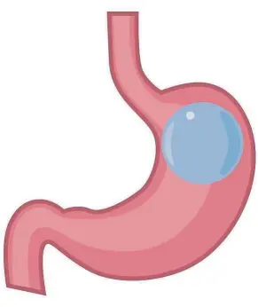  ?? — 123rf.com ?? Gastric balloons are delivered into the stomach via the mouth in an outpatient procedure, which generally takes less than 30 minutes. Once in place, the balloon device is inflated with a sterile solution, which takes up room in the stomach.