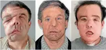  ?? PHOTO: AP ?? These photos show Jerome Hamon before and after his two face transplant­s. The second transplant, after the first one showed signs of rejection, was a medical first, and Hamon is now doing well.