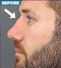  ??  ?? BEFORE The bridge of Ben’s nose had collapsed, left, leaving a bump. Right: How his nose looks now NEW LOOK: