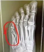  ?? ?? Clear break: The broken toe X-ray