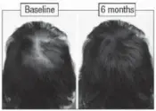  ??  ?? Swiss Scientists Discover Miracle for Reversing Baldness