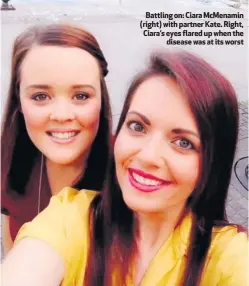  ??  ?? Battling on: Ciara McMenamin (right) with partner Kate. Right, Ciara’s eyes flared up when the
disease was at its worst