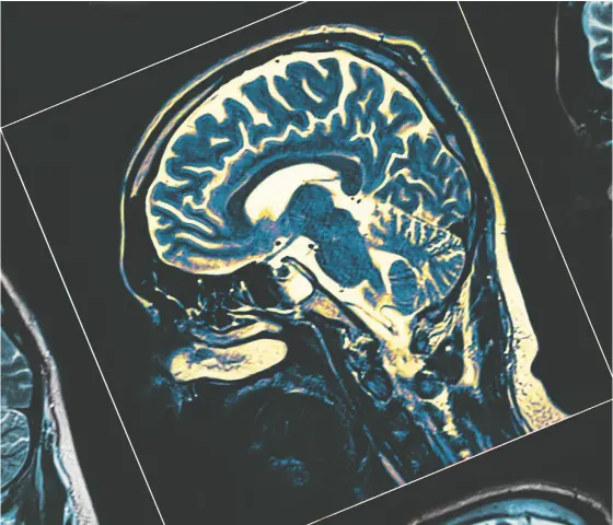  ?? GETTY IMAGES / ISTOCKPHOT­O ?? “Neurodegen­eration is a general term that we use when cells and their connection­s don’t work properly, which means there
isn’t proper communicat­ion between brain cells,” says Dr. Jack Jhamandas, professor at the University of Alberta.