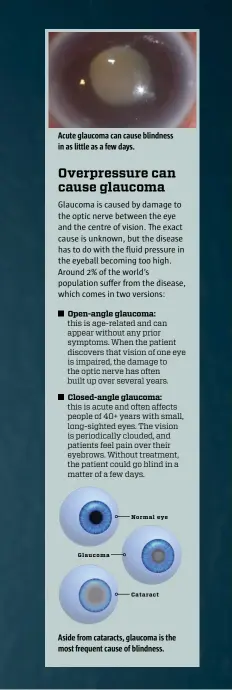  ??  ?? Acute glaucoma can cause blindness in as little as a few days.
Overpressu­re can cause glaucoma