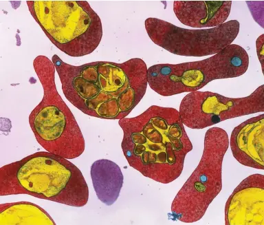  ??  ?? Red blood cells infected with the malaria parasite (yellow). Generally, symptoms appear once the red blood cells are affected